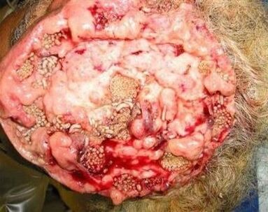 parazitov v ľudskom mozgu